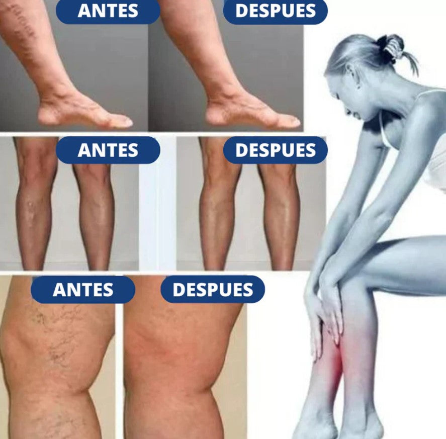 NUEVOS PARCHES PARA VARICES