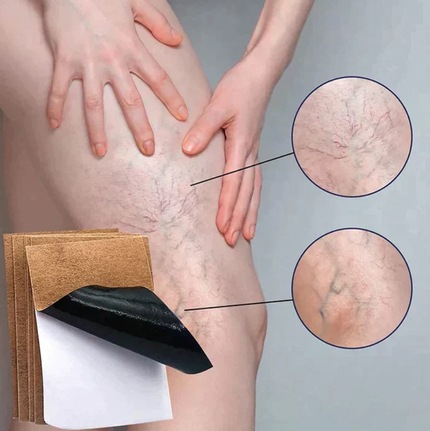 NUEVOS PARCHES PARA VARICES